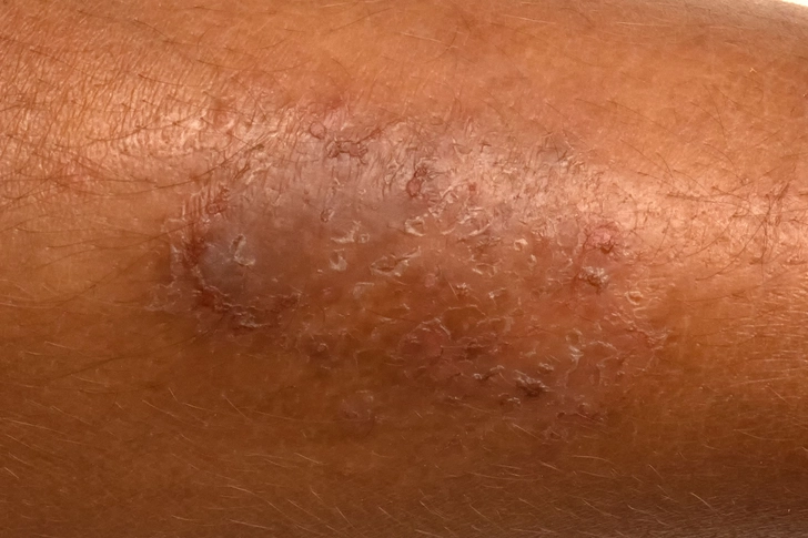 Eczema Eczema