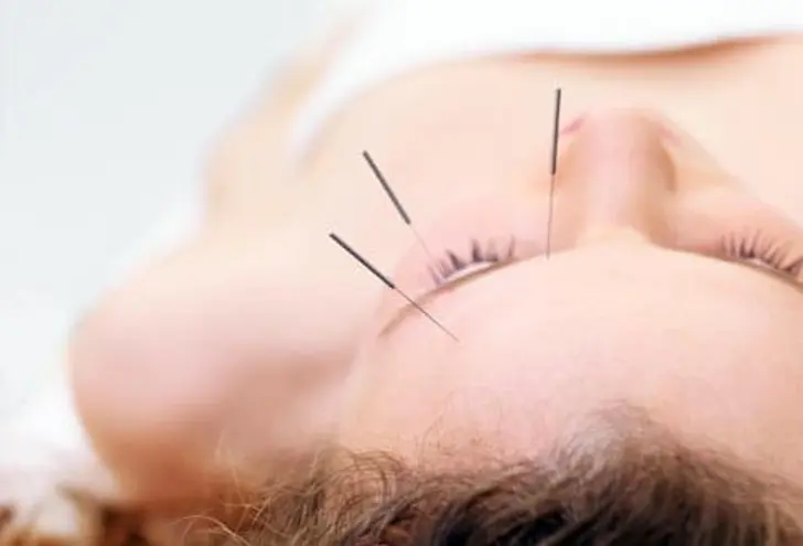 Acupuncture
