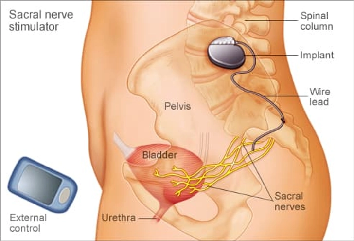 A Stimulator for Your Bladder A Stimulator for Your Bladder