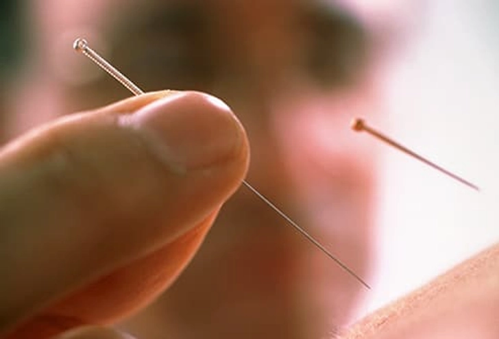 Acupuncture Acupuncture