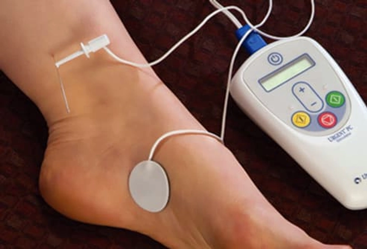 Percutaneous Tibial Nerve Stimulation (PTNS) Percutaneous Tibial Nerve Stimulation (PTNS)