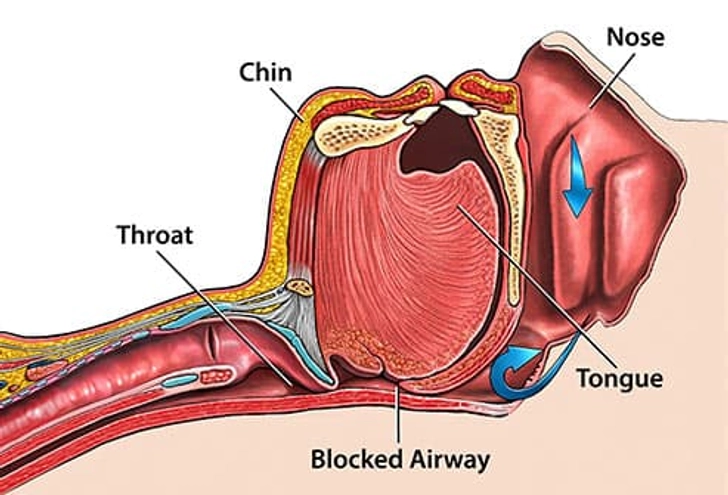 It Blocks Your Breathing