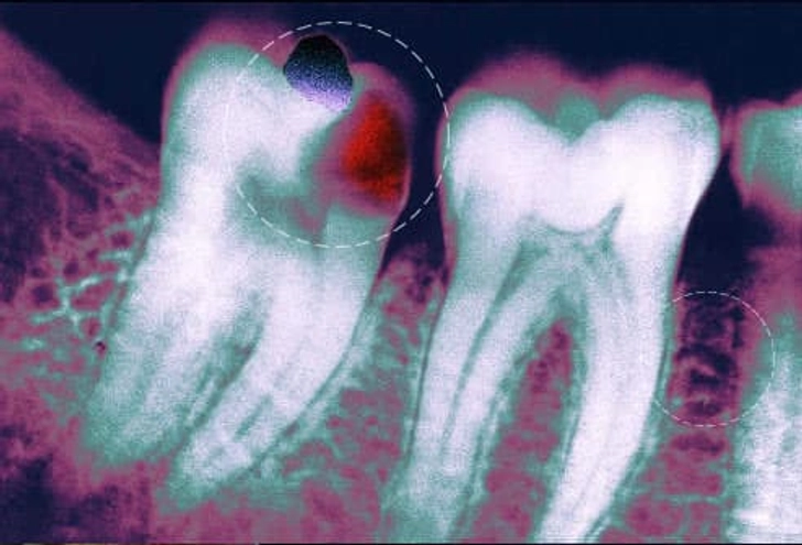 Cavities, Abscesses, Discoloration Cavities, Abscesses, Discoloration