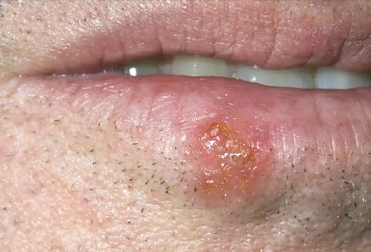 Cold Sores Cold Sores
