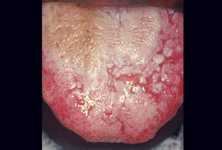 Lichen Planus Lichen Planus