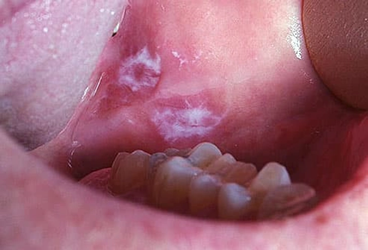 Leukoplakia Leukoplakia