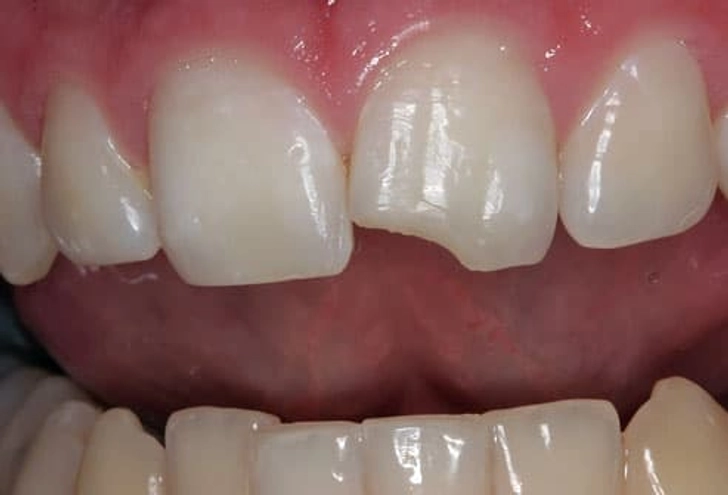 Chipped Teeth