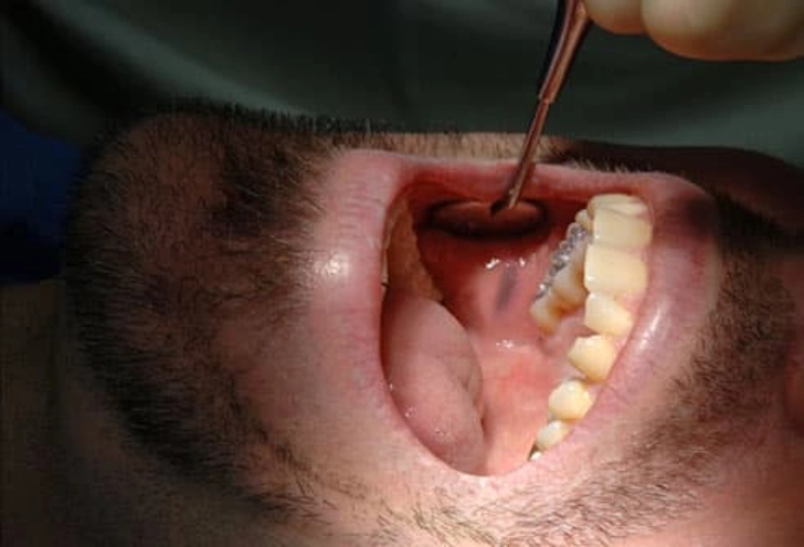Amalgam Tattoo Amalgam Tattoo