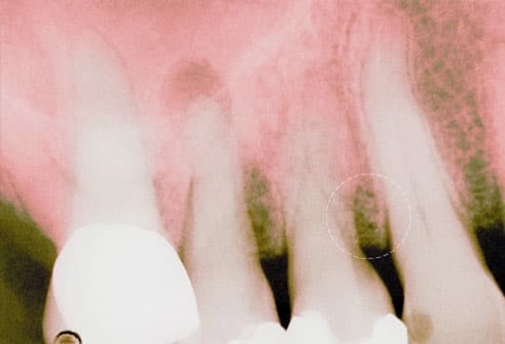 Periodontitis Periodontitis