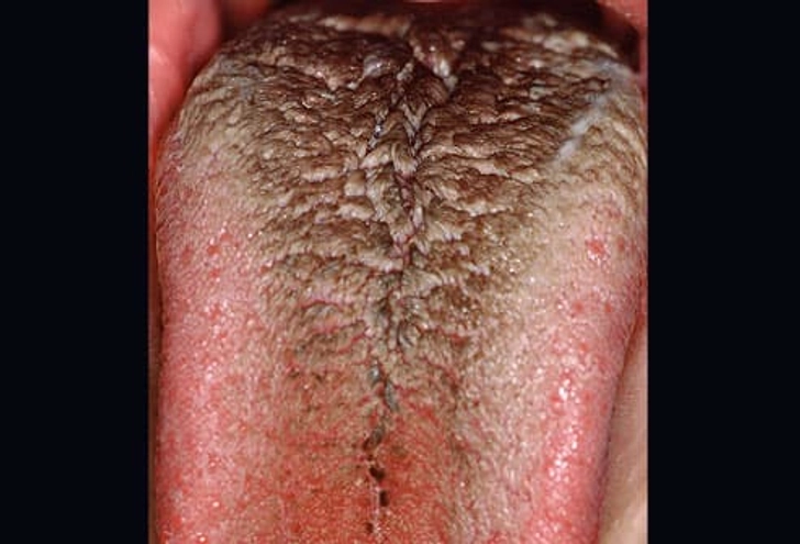 Black Hairy Tongue Black Hairy Tongue
