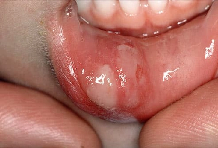 Canker Sores Canker Sores