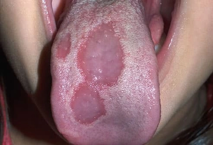 Geographic Tongue Geographic Tongue