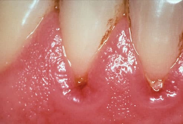 Gum Disease Gum Disease