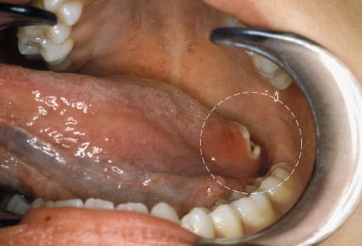Oral Cancer Oral Cancer