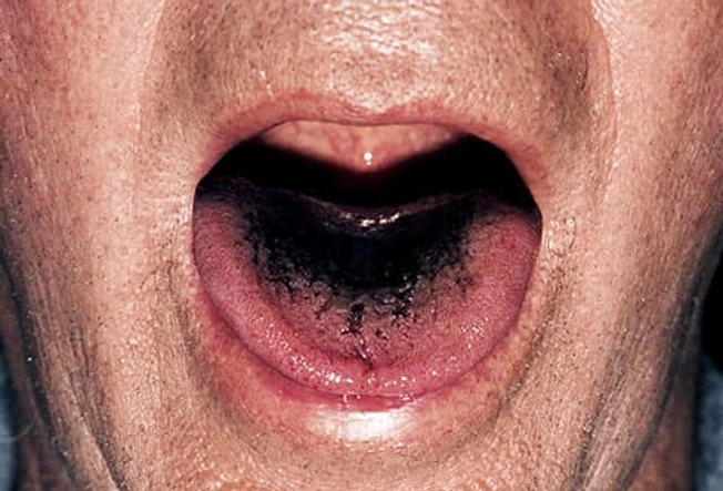Black Tongue