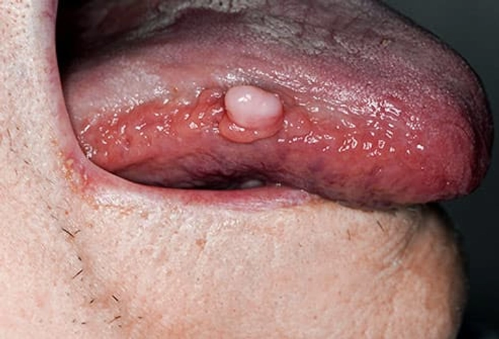 Signs of Mouth Cancer
