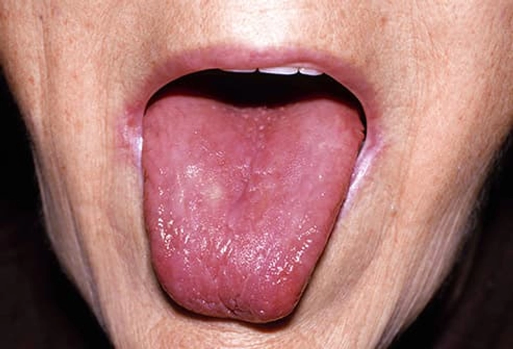 Smooth Tongue