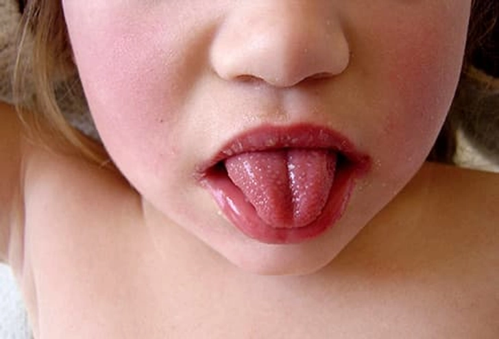 Bright Red Tongue Bright Red Tongue