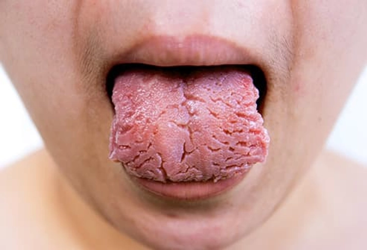 Fissured Tongue