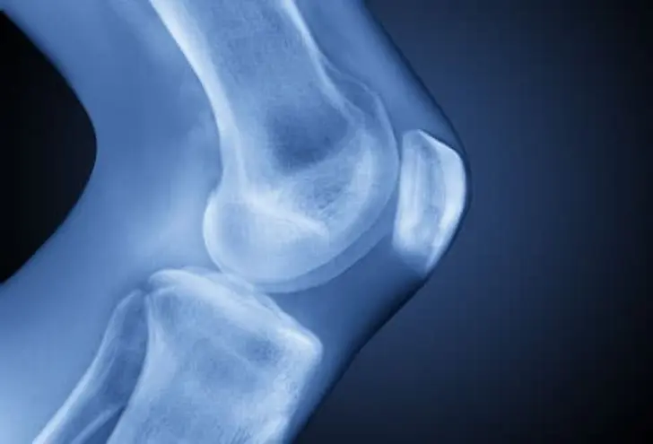 Osteoarthritis: What Is It? Osteoarthritis: What Is It?