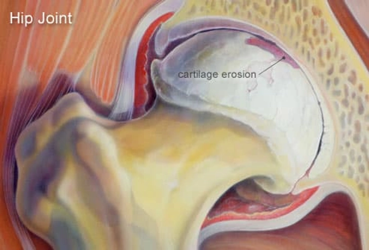 Osteoarthritis: What Causes It? Osteoarthritis: What Causes It?