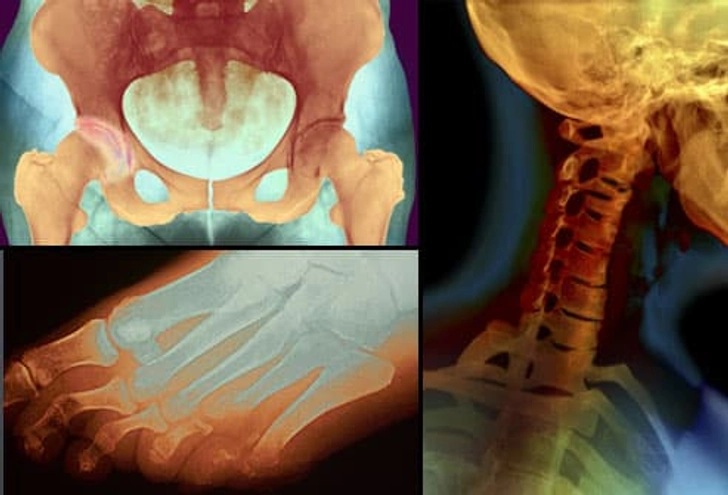 Osteoarthritis: Where Does It Hurt? Osteoarthritis: Where Does It Hurt?
