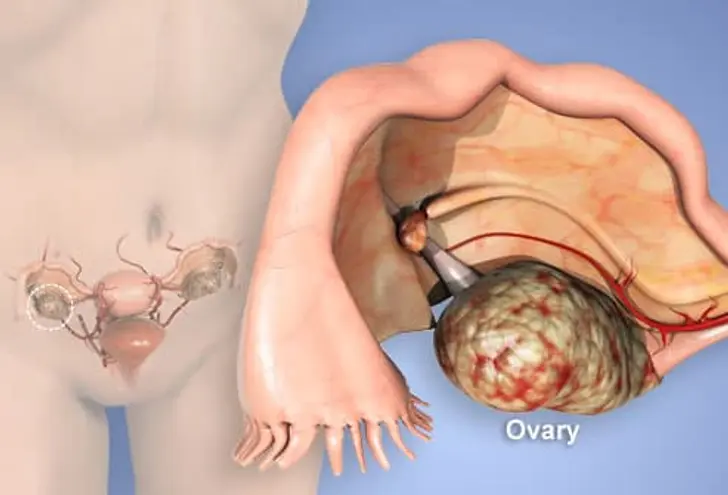 What Is Ovarian Cancer?