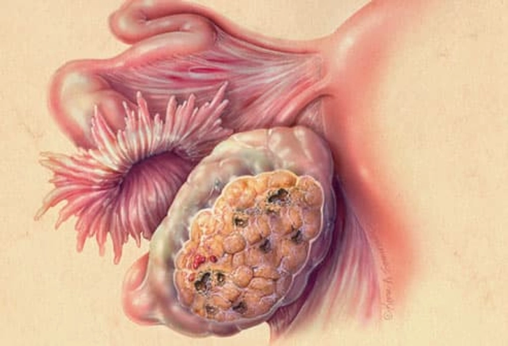 Stages of Ovarian Cancer