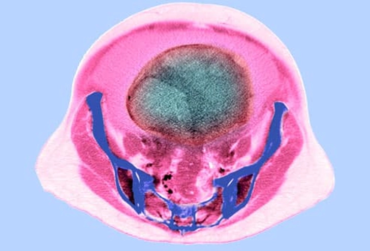 Diagnosing Ovarian Cancer