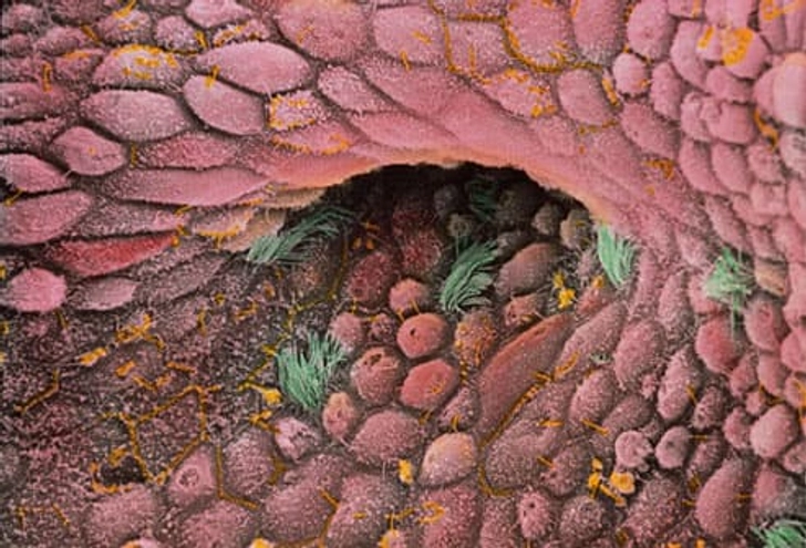 Types of Ovarian Cancer