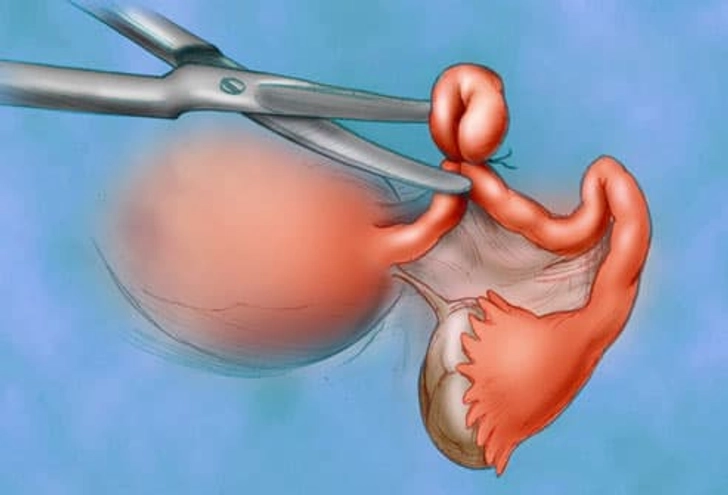 Risk Reducer: Tubal Ligation