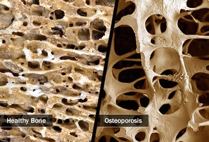 Osteoporosis