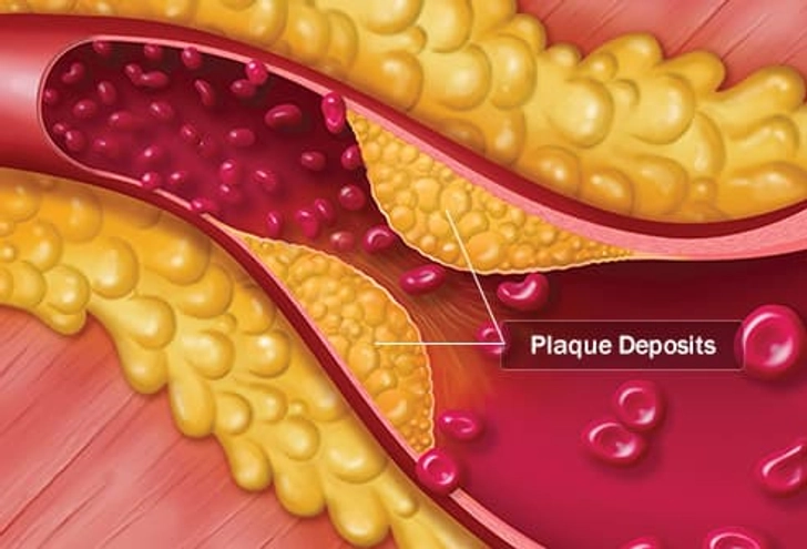 Heart Disease