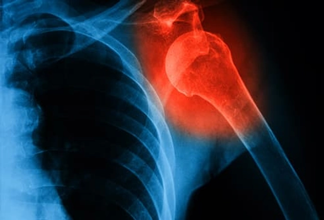 Fracture Fracture