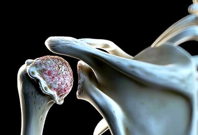 Arthritis Arthritis