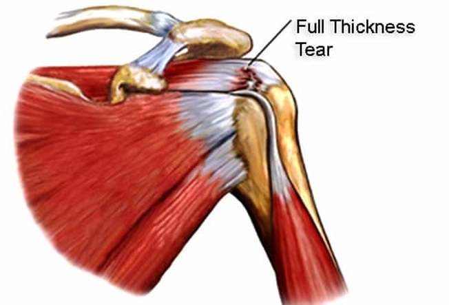 Tendon Tear Tendon Tear