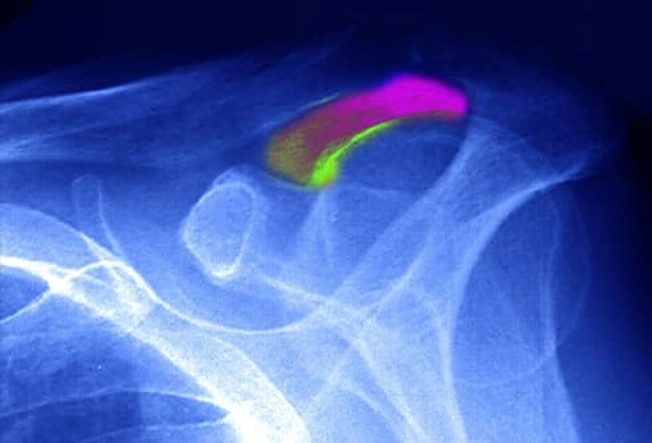 Tendinitis Tendinitis
