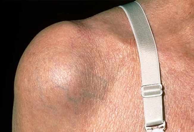 Bursitis Bursitis