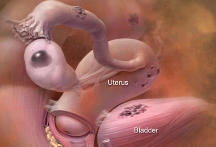 Endometriosis