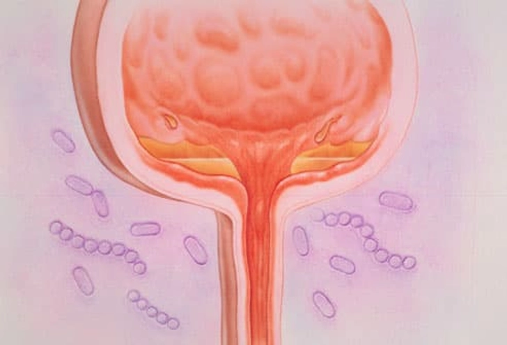 Interstitial Cystitis (IC) Interstitial Cystitis (IC)