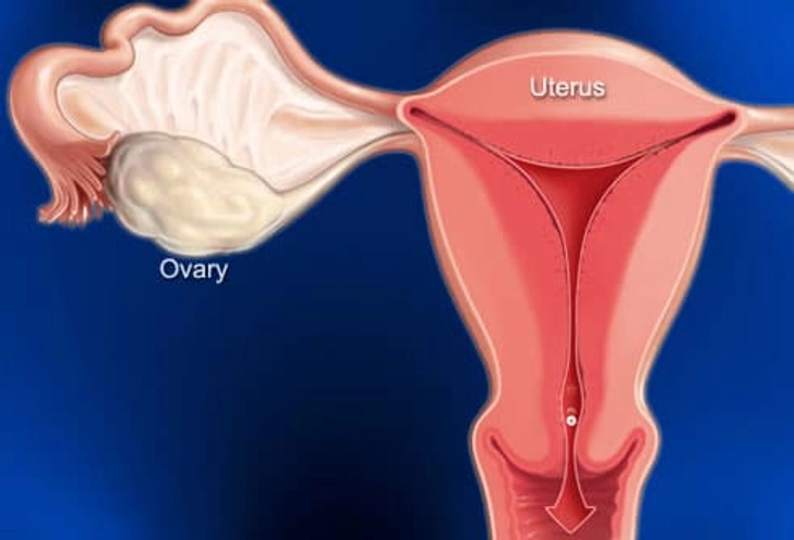 PMS and Menstrual Cramps