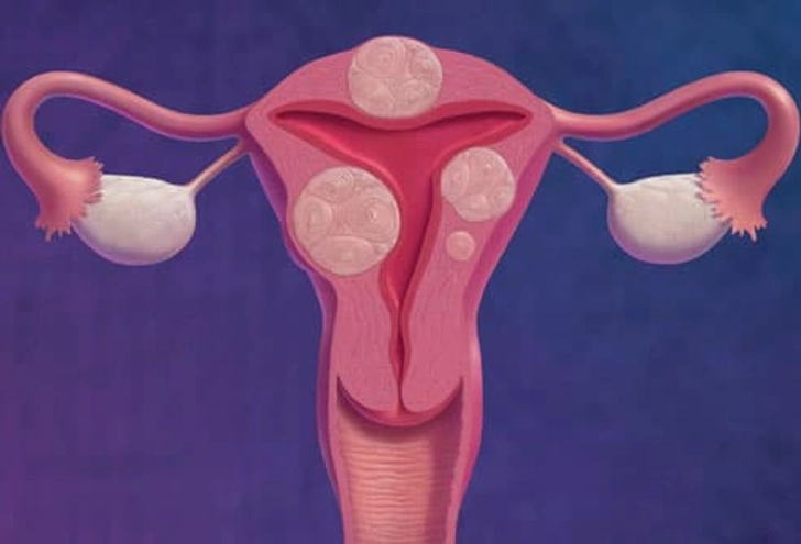 Uterine Fibroids
