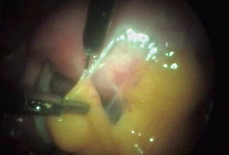 Scar Tissue Scar Tissue