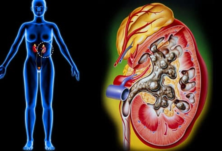 Kidney Stones Kidney Stones
