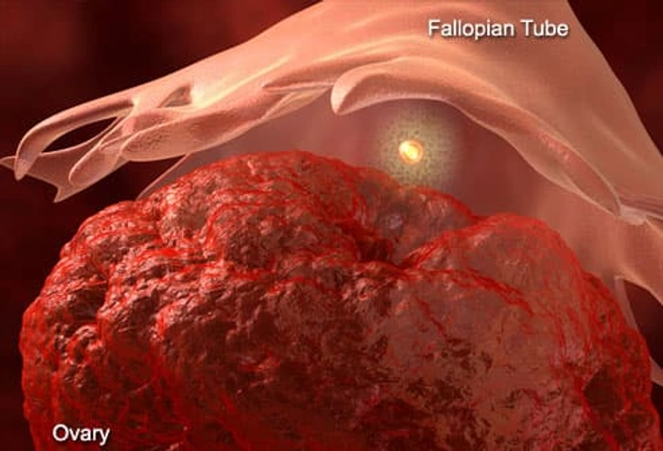 Mittelschmerz (Painful Ovulation)