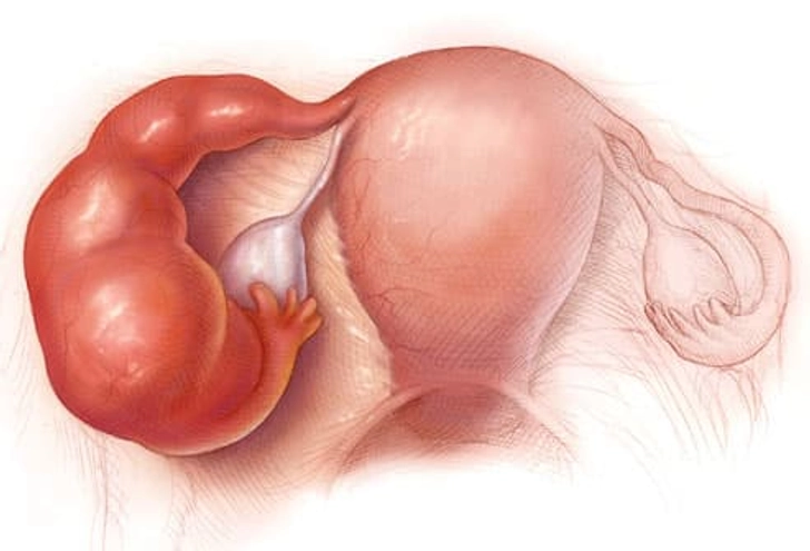 Pelvic Inflammatory Disease