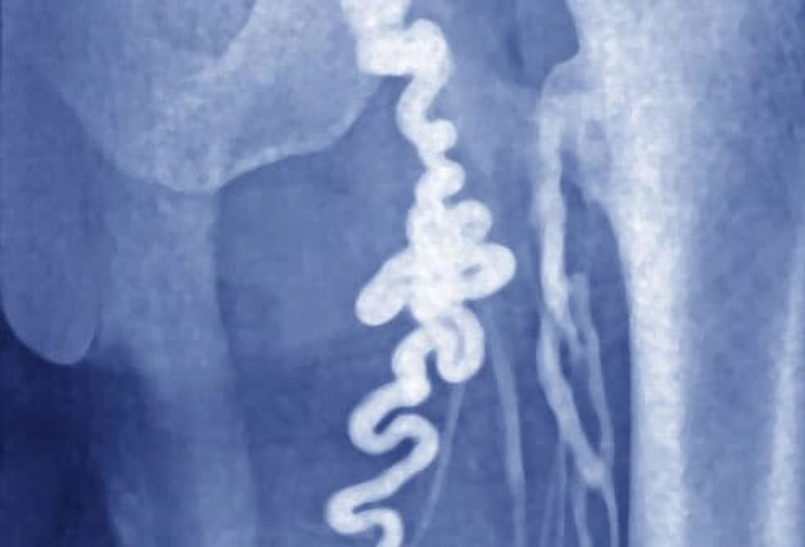 Pelvic Congestion Syndrome