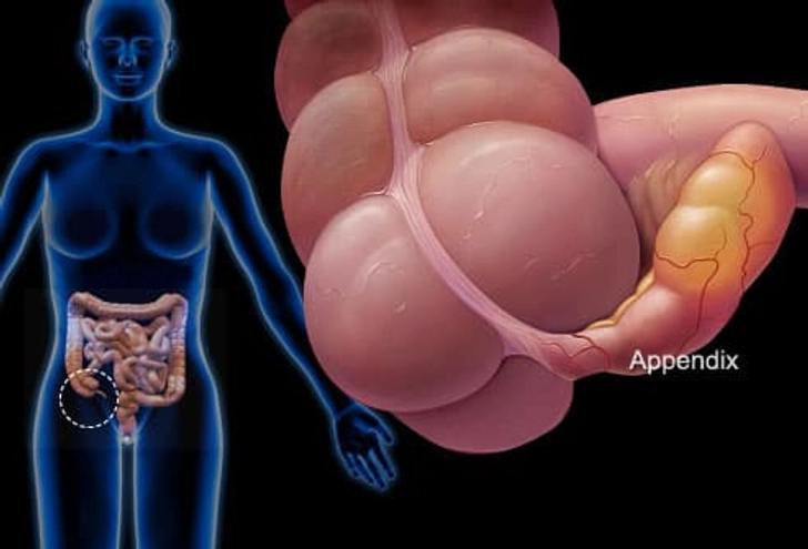 Appendicitis