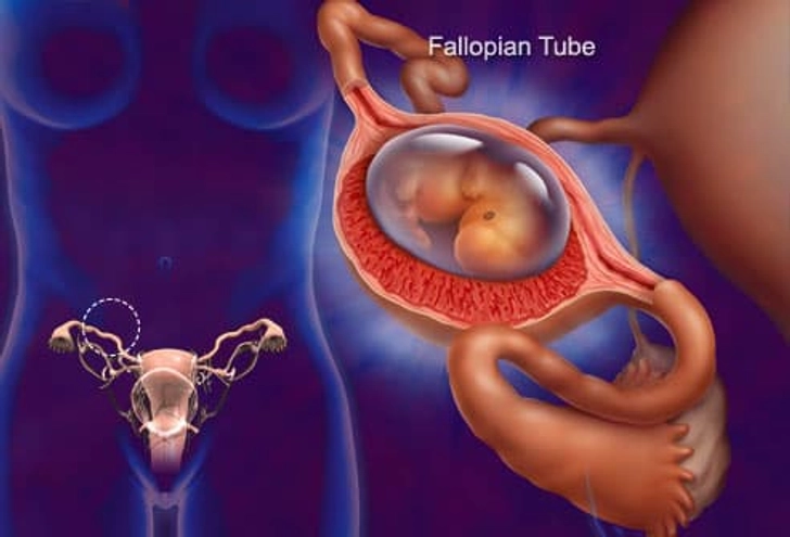 Ectopic Pregnancy