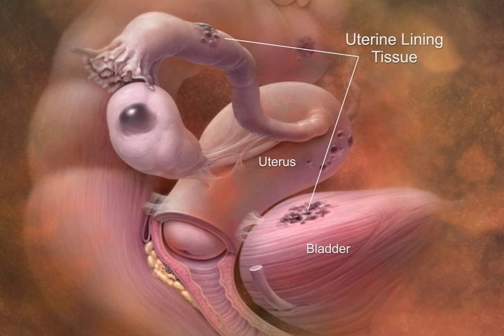 Other Cramps